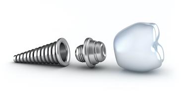 Dental implant and crown at dentist in Brandon, FL