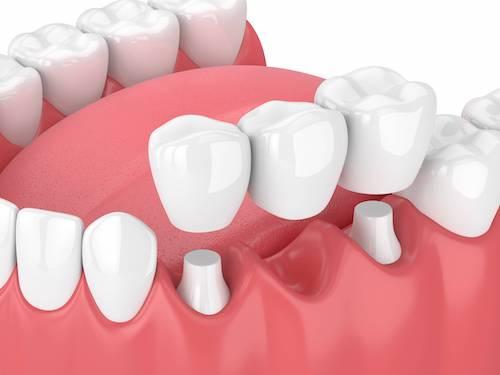 Diagram of dental bridge in Brandon, FL