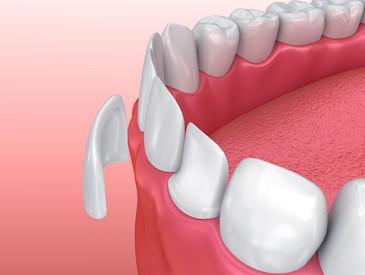 Diagram of veneer covering tooth in Brandon, FL