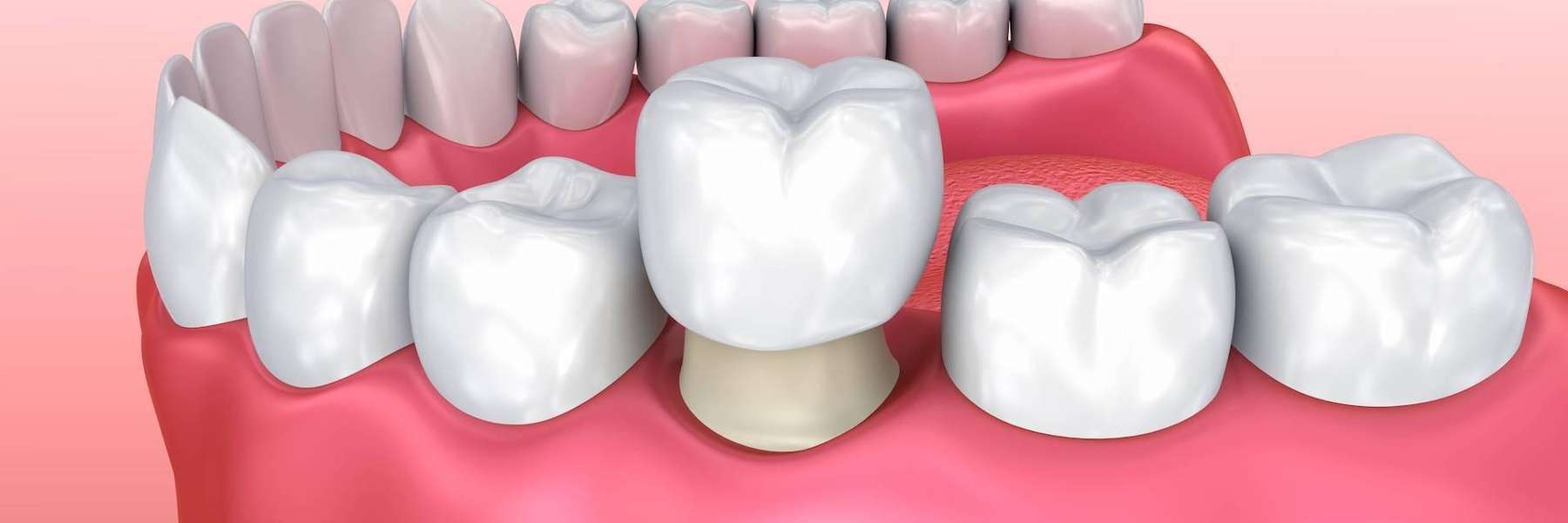 An illustration of a dental crown | full mouth reconstruction