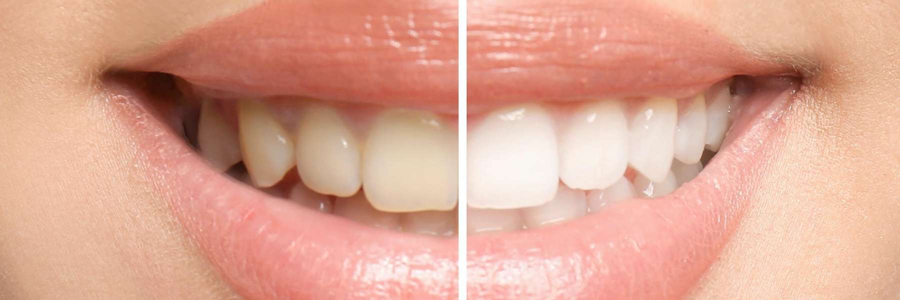 before and after teeth whitening