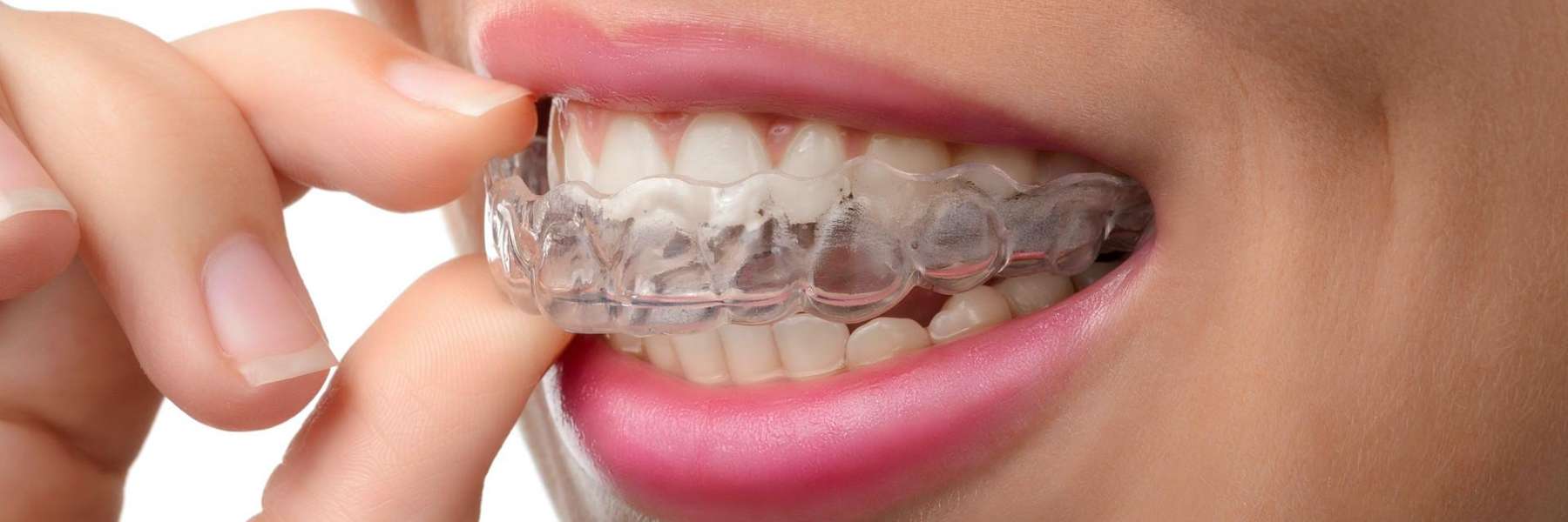 A woman putting in her Invisalign tray | dentist Brandon, FL