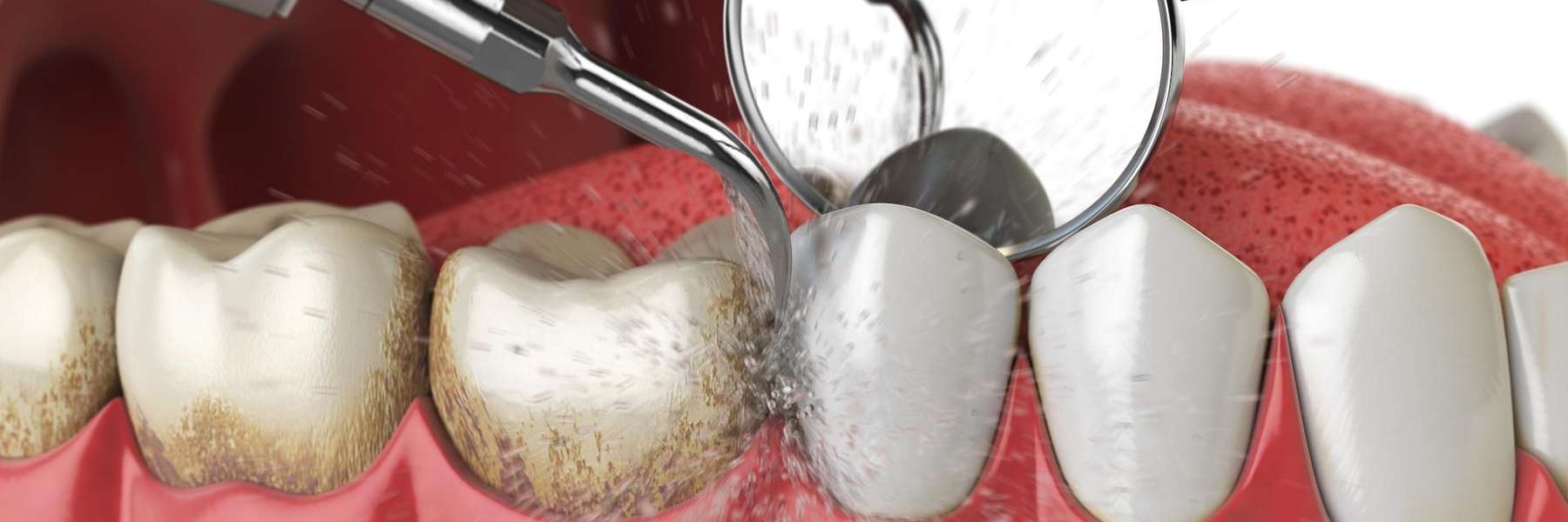 An illustration of a teeth cleaning | cavities Brandon FL