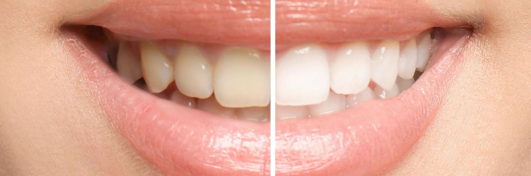 before and after teeth whitening results in brandon fl