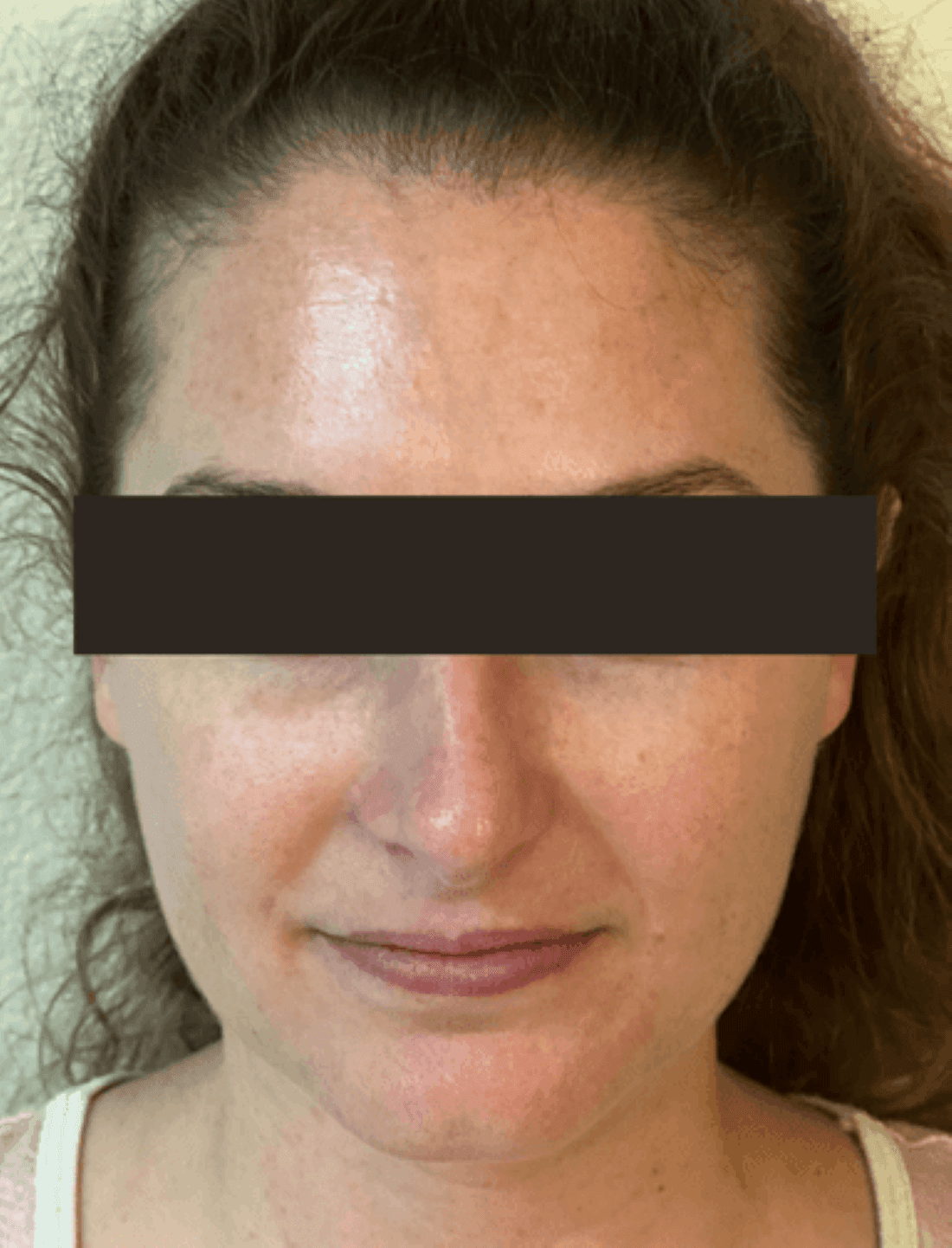 Results from BOTOX injections at dentist in Brandon, FL