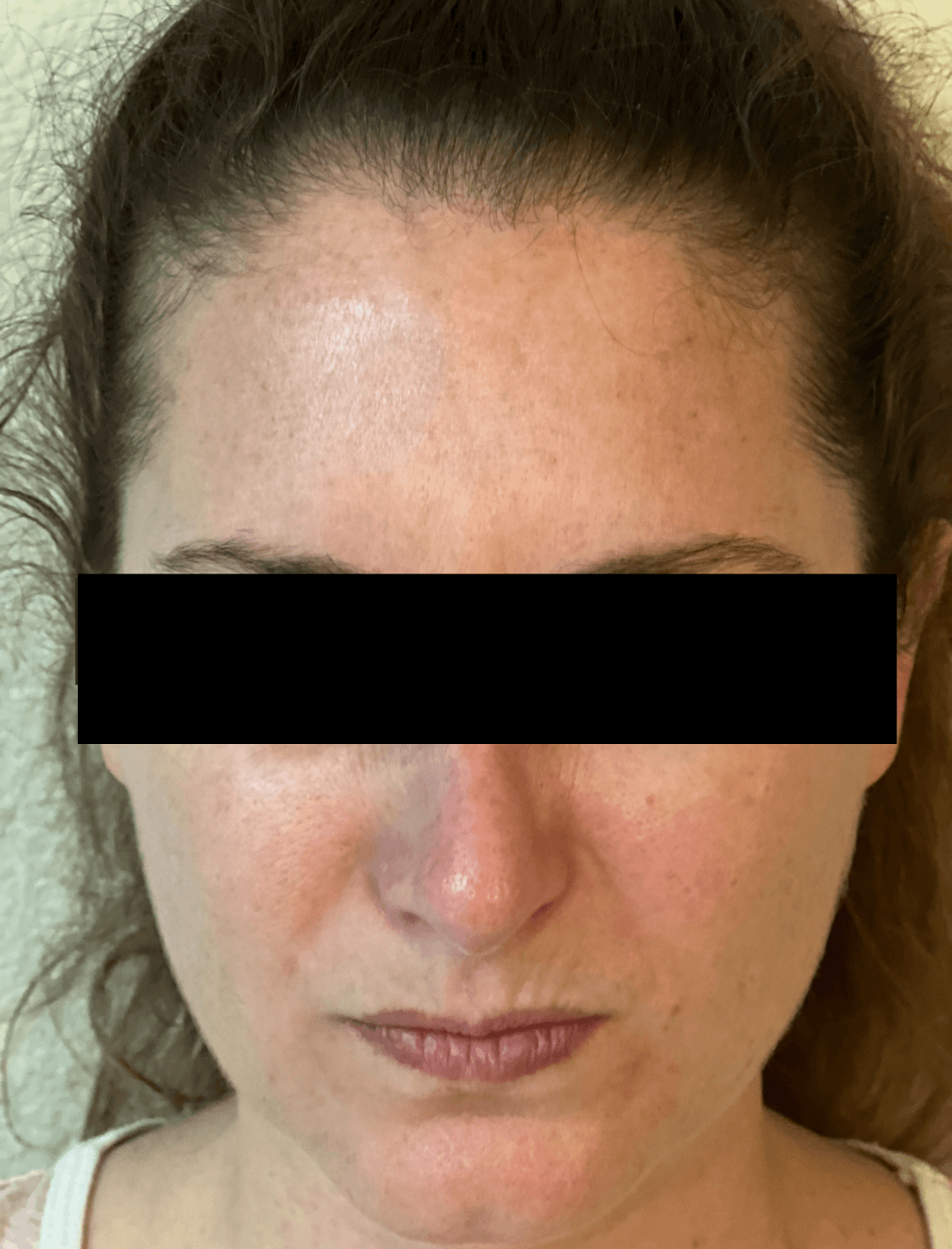 Patient with smooth skin after BOTOX injections at Brandon, FL dentist