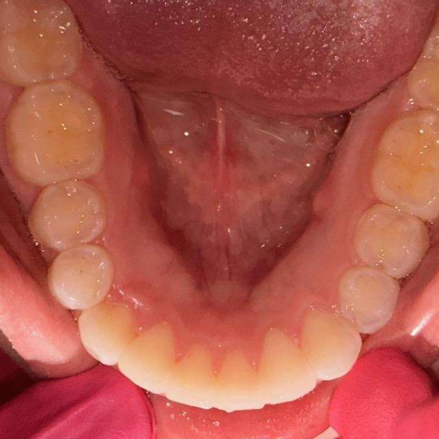 Bottom row of teeth after Invisalign