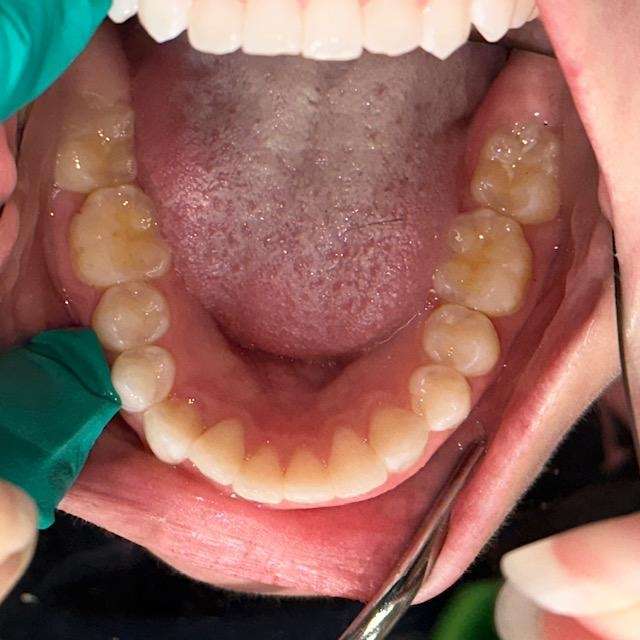 Bottom row of teeth before Invisalign
