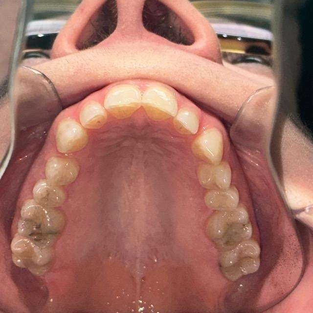 Patient upper row of teeth before Invisalign in Brandon FL