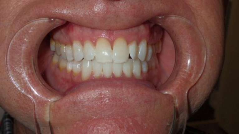 Results from professional teeth whitening treatment in Brandon, FL