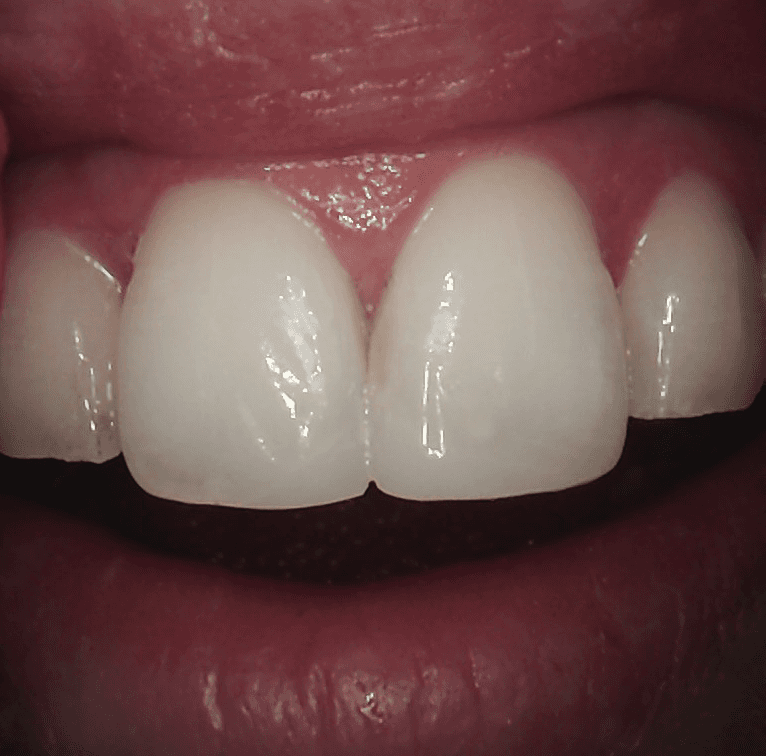 Composite-Bonding-After-Image
