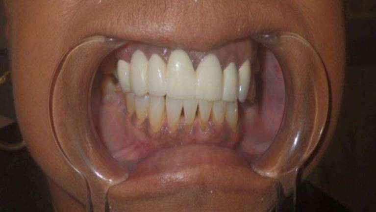 Results from teeth whitening at dentist in Brandon, FL