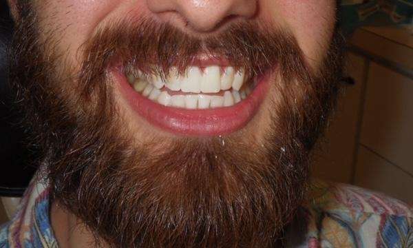 Zoom-Whitening-After-Image