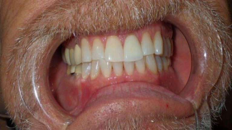 Results after Zoom! teeth whitening in Brandon, FL