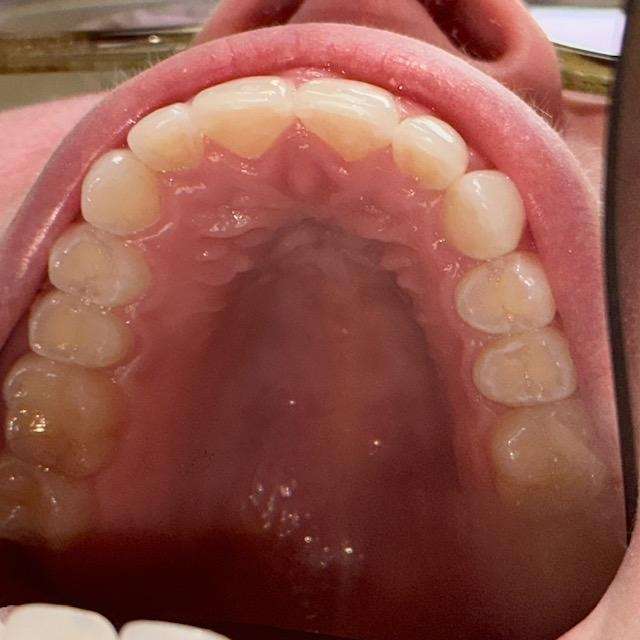 Upper row of teeth after Invisalign