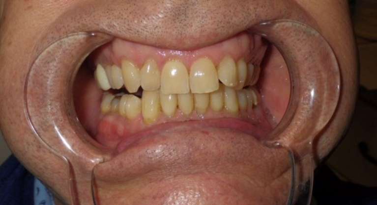 Yellow teeth before professional whitening treatment in Brandon, FL