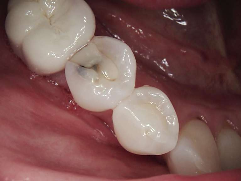 Composite-Fillings-Before-Image