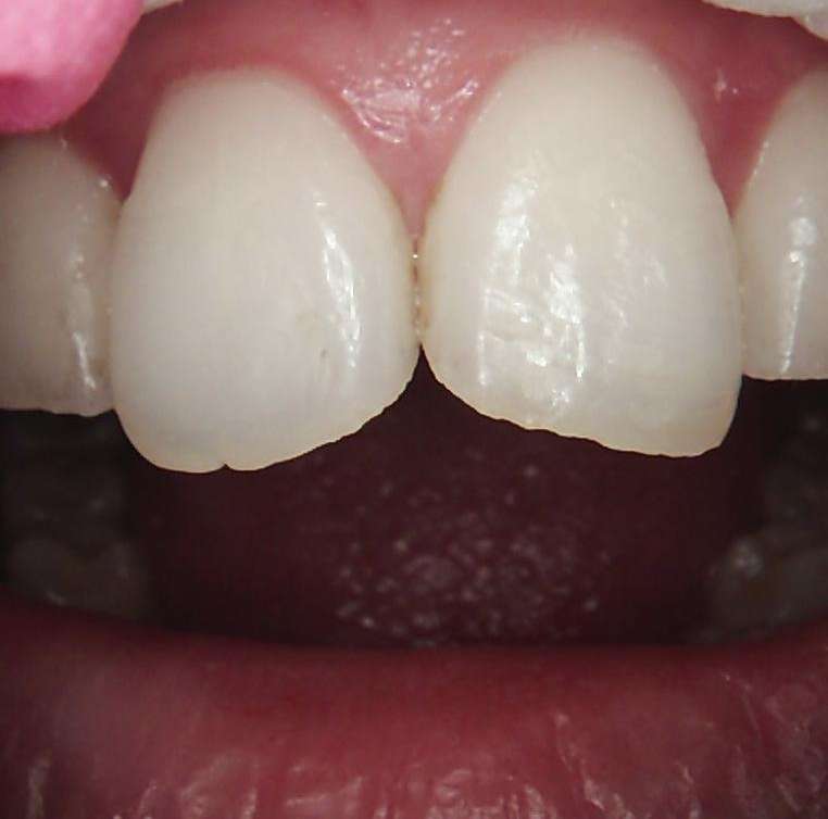 Composite-Bonding-Before-Image