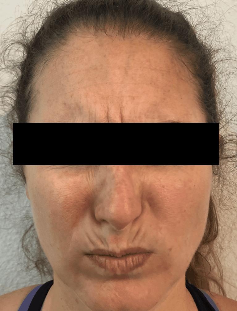 Glabellar-11-s-Lines-Before-Image