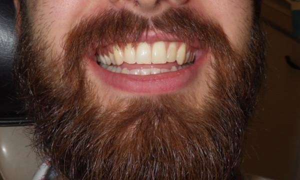 Zoom-Whitening-Before-Image