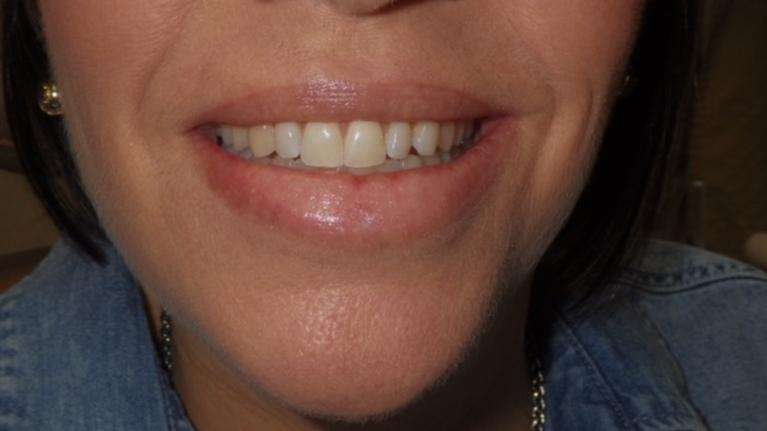Zoom-Whitening-Before-Image